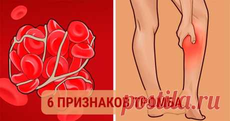 Не игнорируй это. Симптоматика наличия в организме тромба — Полезные советы