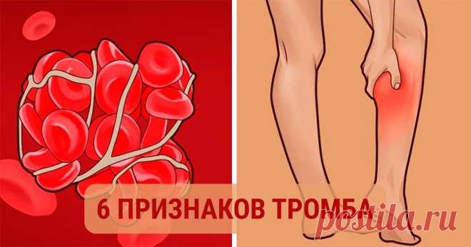 Не игнорируй это. Симптоматика наличия в организме тромба — Полезные советы