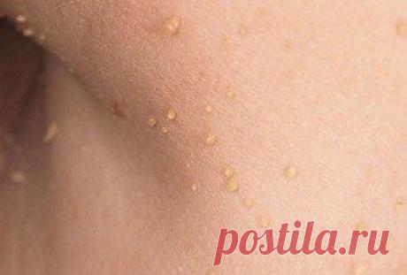 Откуда берутся папилломы? | Med62.ru | Яндекс Дзен