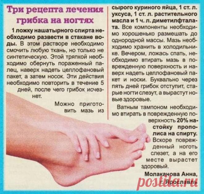 3 рецепта лечения грибка на ногтях