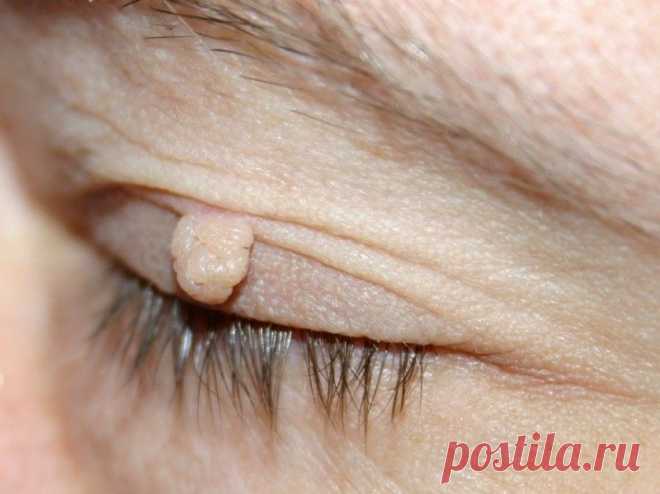 Гениально простой способ быстро избавиться от бородавок