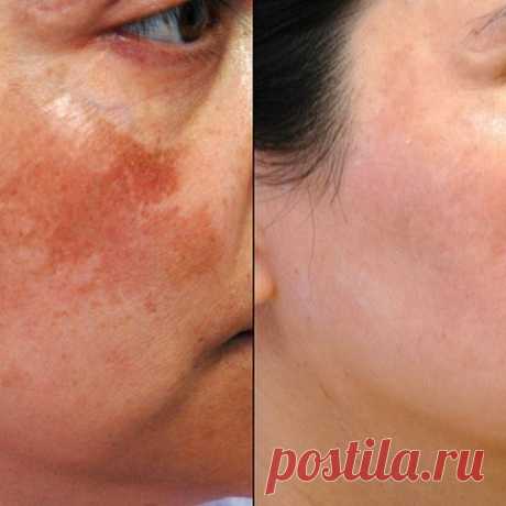 Простые домашние отбеливающие маски - поразительный результат!