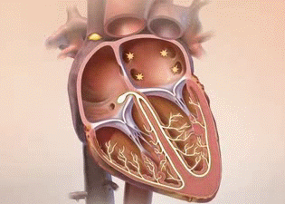 E-Cardio: Фибрилляция предсердий