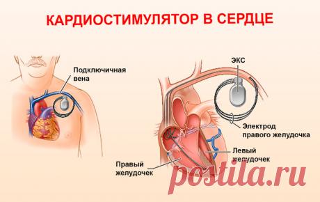 Кардиостимулятор сердца: противопоказания по возрасту, стоимость операции, показания к установке, отзывы пациентов, видео