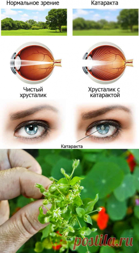 От катаракты простое лечение, в обычной травке - глаз спасение