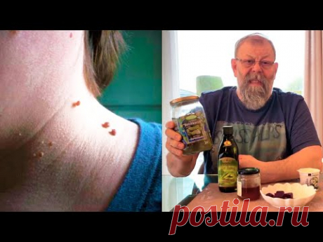 О чем расскажут папилломы и чего нельзя делать категорически