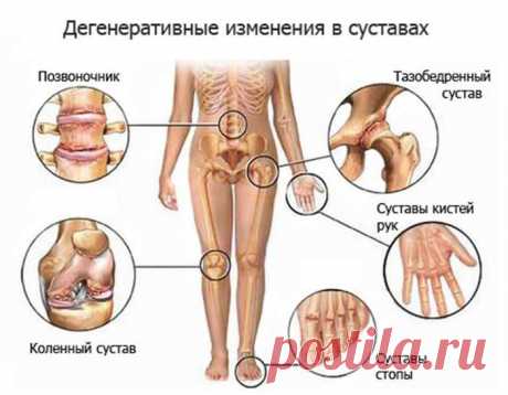 Проблемы с суставами можно исправить! Спасайте своих близких!