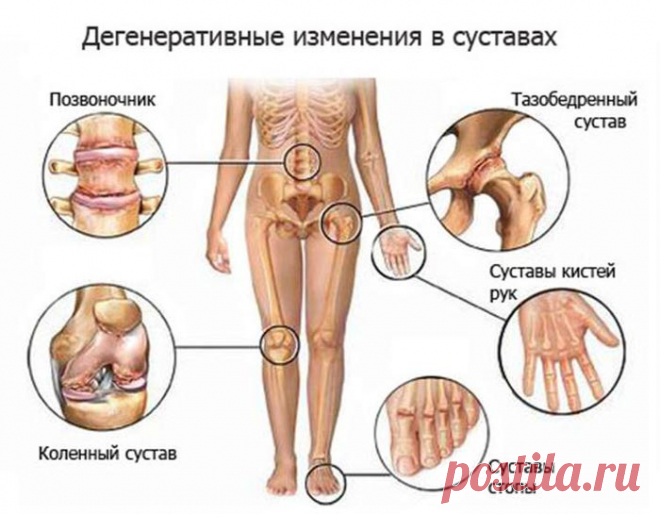 Проблемы с суставами можно исправить! Спасайте своих близких!