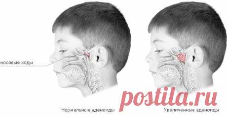 Как вылечить аденоиды самостоятельно!