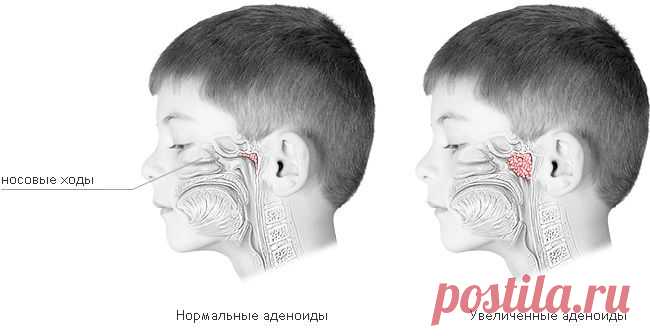 Как вылечить аденоиды самостоятельно!