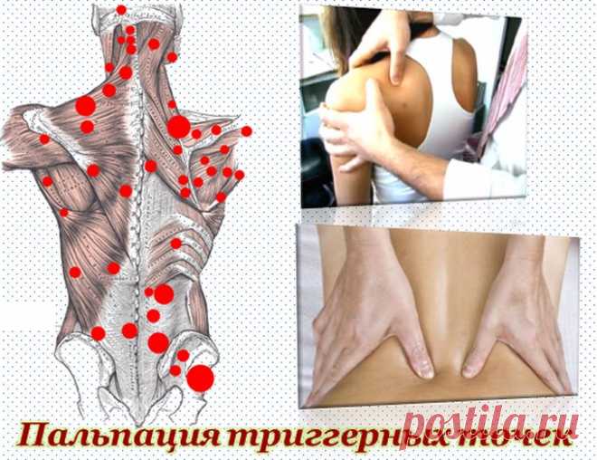 Триггерные точки. Что это такое?