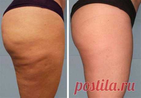 Медовый массаж от целлюлита