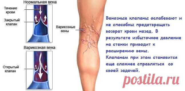 Причины варикоза ног и его устранение — Всегда в форме!