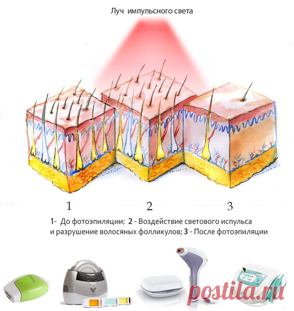 Фотоэпиляция в домашних условиях: выбираем лучшие фотоэпиляторы для дома