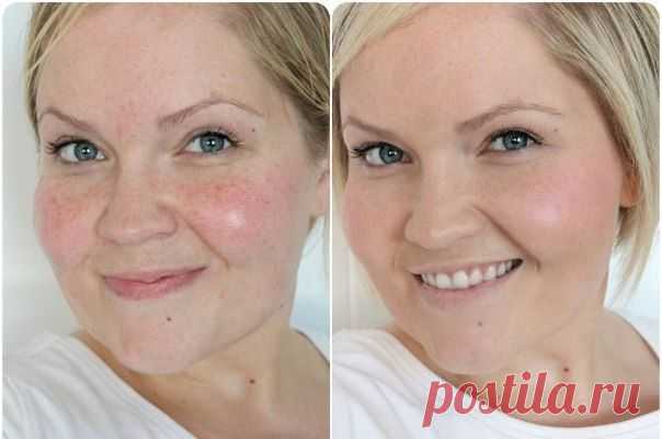 Ровный цвет лица без тоналки! Народные рецепты