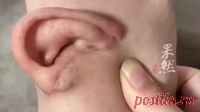 Женщина 5 месяцев носила свое оторванное ухо на ноге, ожидая операцию по пересадке. Женщина из Китая пять месяцев носила свое оторванное ухо на ноге, ожидая операцию по пересадке, пишет Oddity Central. В провинции Шаньдун женщина получила производственную травму: ее волосы попали в механизм оборудования, что привело к ...