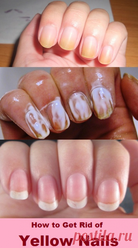 How to Get Rid of Yellow Nails | Virtual Clinic