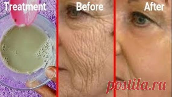 Мощное лечение от старения кожи, все тонкие линии и морщины исчезнут всего за несколько дней Я собираюсь поделиться очень простым лечением, которое удалит все симптомы старения с вашей кожи, которые появляются в раннем возрасте из-за стресса и загрязнения.