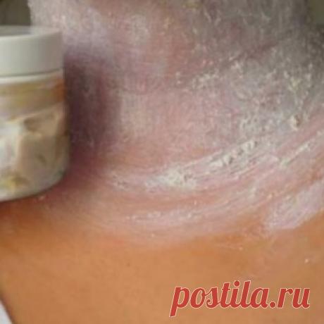 Избавьтесь от этих темных пятен на шее, в области подмышек и внутренней поверхности бедер!
