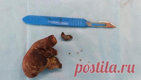 Российские врачи спасли женщину с гигантским камнем в почке. Врачи Городской клинической больницы N1 в Чебоксарах спасли пациентку с огромным камнем в почке. Об этом сообщили в пресс-службе Минздрава Чувашской Республики. Как рассказал заведующий урологическим отделением больницы Сергей Тимофеев, ...