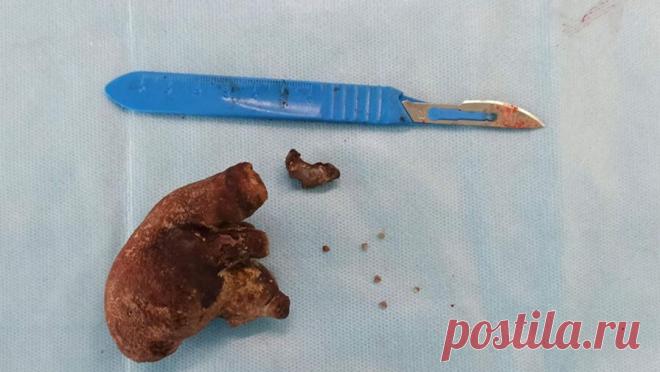 Российские врачи спасли женщину с гигантским камнем в почке. Врачи Городской клинической больницы N1 в Чебоксарах спасли пациентку с огромным камнем в почке. Об этом сообщили в пресс-службе Минздрава Чувашской Республики. Как рассказал заведующий урологическим отделением больницы Сергей Тимофеев, ...