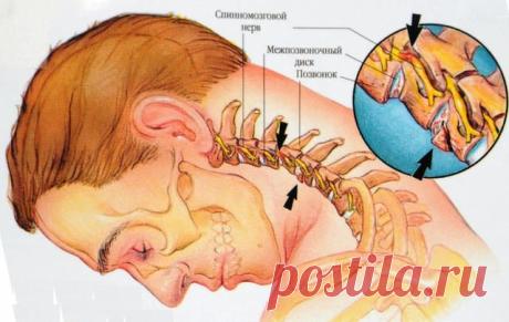 Йога против шейного остеохондроза