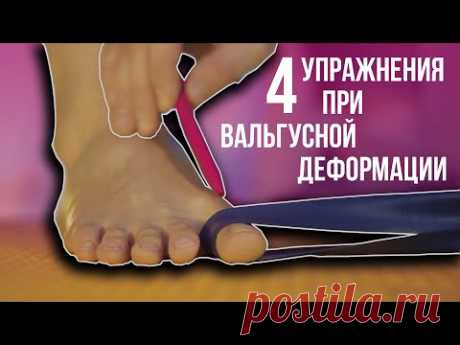 4 упражнения при вальгусной деформации