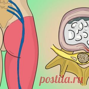 Одно простое упражнение чтобы избавиться от боли в пояснице и защемления седалищного нерва.