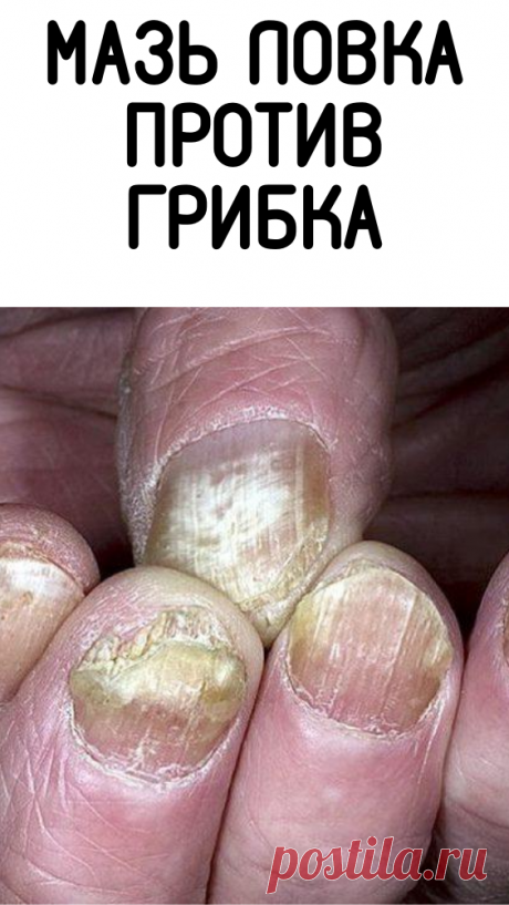 Мазь ловка против грибка Рецепты Приготовления