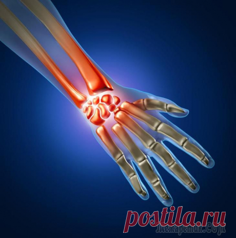 Туннельный синдром запястья— профилактика и лечение