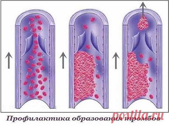 Профилактика образования тромбов.