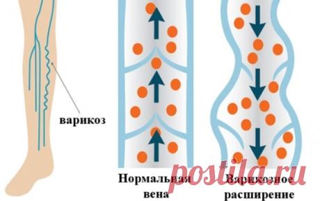 ЗАЧЕМ ОРГАНИЗМУ ВАРИКОЗ 

Раз что-то появляется в нашем теле, то значит зачем-то оно нужно. Варикоз - это сигнал. Точнее, уже сигналище. 

Организм постоянно с нами общается и сообщает о проблемах в разных его уголках. Просто мы иногда этого не замечаем. А еще чаще пьем таблетку и все проходит. Важно знать, что если: 
Показать полностью…