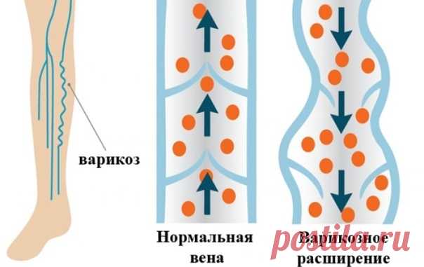 ЗАЧЕМ ОРГАНИЗМУ ВАРИКОЗ 

Раз что-то появляется в нашем теле, то значит зачем-то оно нужно. Варикоз - это сигнал. Точнее, уже сигналище. 

Организм постоянно с нами общается и сообщает о проблемах в разных его уголках. Просто мы иногда этого не замечаем. А еще чаще пьем таблетку и все проходит. Важно знать, что если: 
Показать полностью…