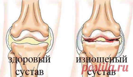 Артроз: знакомая избавилась от страшных болей и поделилась, как она это сделала. Простые рецепты, но очень эффективные! - Образованная Сова