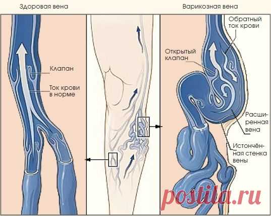Лечение варикозного расширения вен.