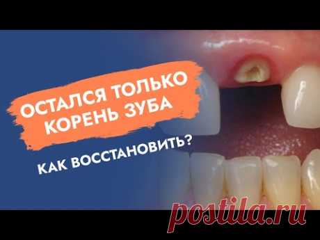 Остался только корень зуба. Как восстановить?