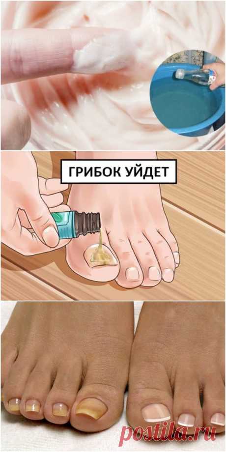 От этой смеси исчезает грибок на ногах и руках. Мгновенный результат! | Всё для Тебя