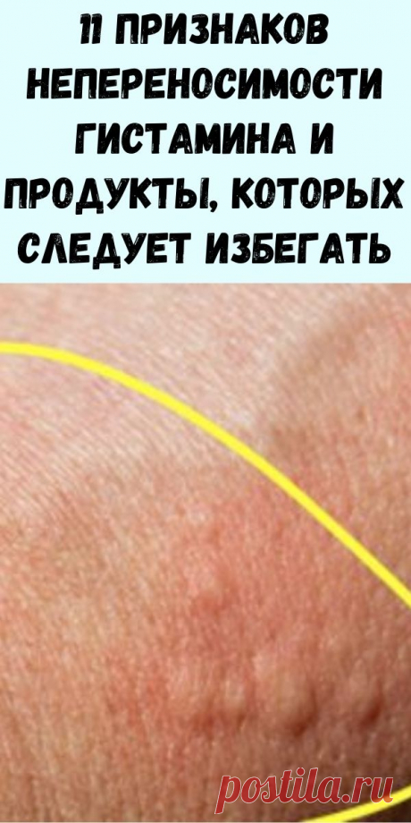 11 признаков непереносимости гистамина и продукты, которых следует избегать - Журнал для женщин