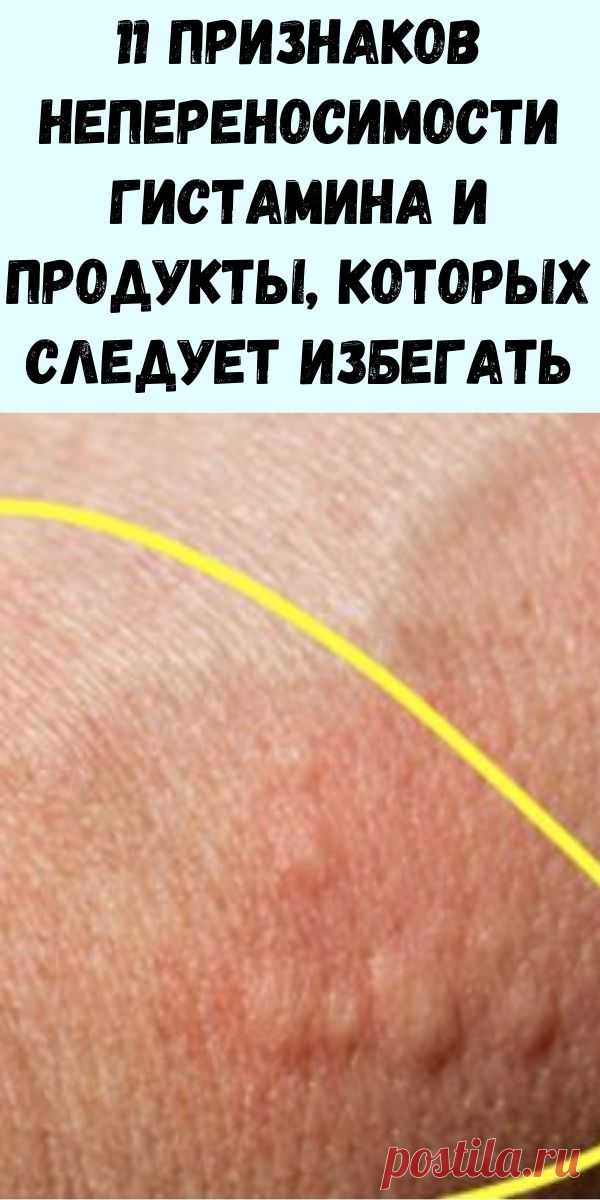 11 признаков непереносимости гистамина и продукты, которых следует избегать - Журнал для женщин
