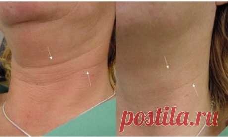 Коррекция морщин шеи в Киеве: цена. Лицензия МОЗ - Coolaser Clinic