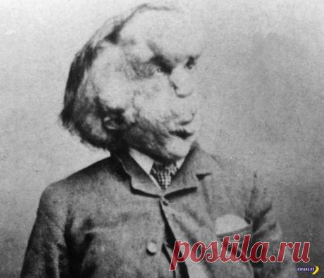 Человек-слон Джозеф Меррик и его череп | Чёрт побери