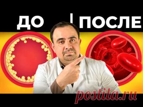 Закупорка Артерий и Риск Инсульта: Что Делать?