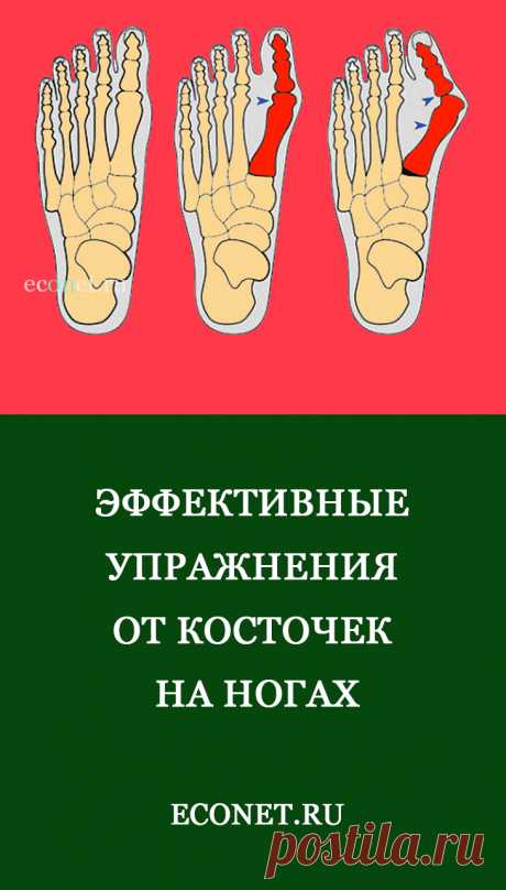 Эффективные упражнения от косточек на ногах

Появление вальгусной деформации стопы, или так называемых «косточек» на ногах, может очень сильно беспокоить обладателя этого неприятного заболевания, доставляя дискомфорт во время ходьбы и порождая определенные проблемы при подборе удобной обуви.