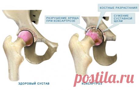 коксартроз тазобедренных суставов - 705 картинок. Поиск@Mail.Ru