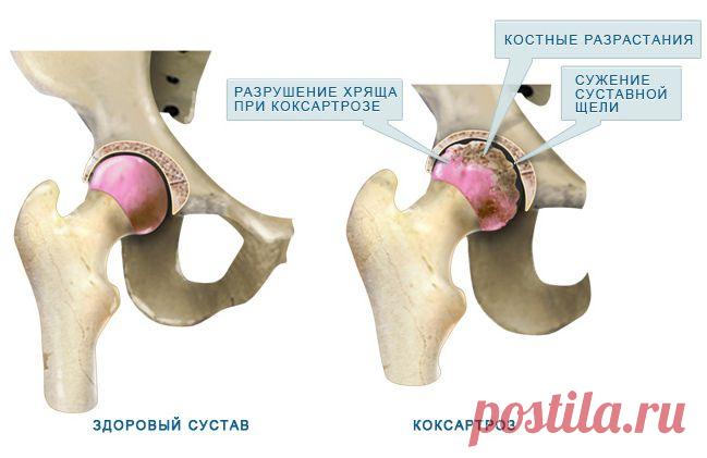 коксартроз тазобедренных суставов - 705 картинок. Поиск@Mail.Ru
