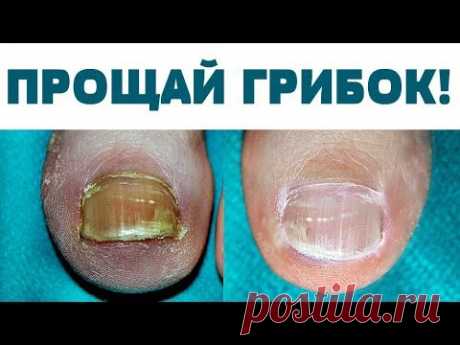 Купила в аптеке ЗА КОПЕЙКИ сильнейшее СРЕДСТВО  от ГРИБКА ногтей и стоп
