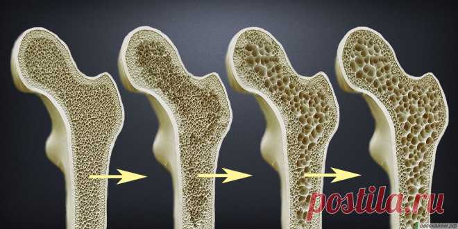 Как нужно ходить, чтобы избежать остеопороза? Остеопороз перестал быть болезнью исключительно пожилых людей. Сегодня его признаки обнаруживают даже у тридцатилетних, и виной тому — наш малоподвижный образ жизни. Кости, лишенные нагрузки, начинают терять плотность, словно ненужный строительный материал. Но есть хорошая новость: обычная ходьба может стать мощным оружием против этого процесса. Почему ежедневные прогулки могут укрепить кости? ...