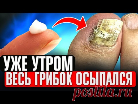 Даже за 4 мин. Грибок осыпается! Запомни 1 народный способ как избавиться от грибка ногтей (важно)