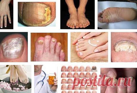 Грибковое заболевание ногтей – как лечить онихомикоз | Лечение народными средствами в домашних условиях