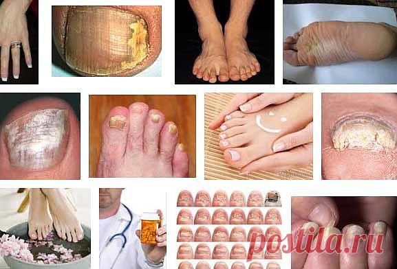 Грибковое заболевание ногтей – как лечить онихомикоз | Лечение народными средствами в домашних условиях